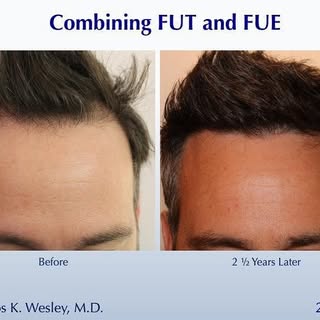 #BeforeAndAfterMondays 
.
.
.
.
.
To schedule an appointment with @drcarloswesley: Link in the bio. 