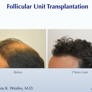 #BeforeAndAfterMondays  #BAM
.
.
.
.
.
To schedule an appointment with @drcarloswesley: Link in the 