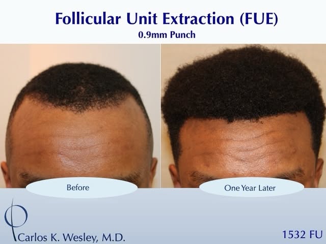 #BeforeAndAfterMondays #BAM
.
.
.
.
.
To schedule an appointment with @drcarloswesley: Link in the b