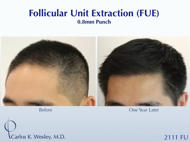 #BeforeAndAfterMondays #BAM
.
.
.
.
.
To schedule an appointment with @drcarloswesley: Link in the b