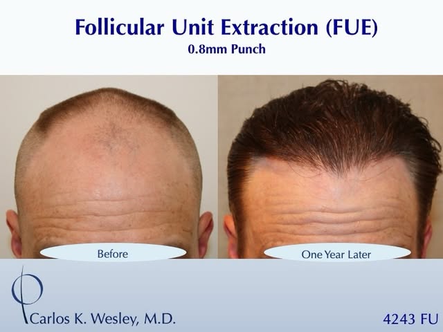 #BeforeAndAfterMondays #BAM
.
.
.
.
.
To schedule an appointment with @drcarloswesley: Link in the b