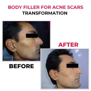 Body Filler for Acne Scars transformation journey ✨

Treatment plan:
Body filler is an injectable de