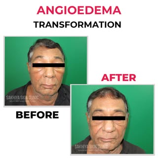 Angioedema transformation journey✨

Treatment plan: Angioedema is a transient, localized, non-pittin