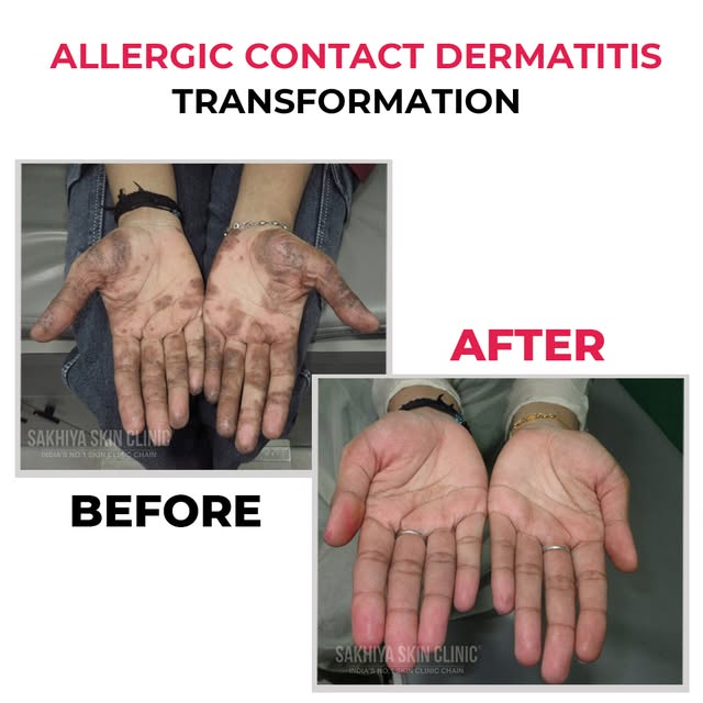 Allergic Contact Dermatitis transformation journey ✨

Treatment plan :

Allergic Contact Dermatitis 