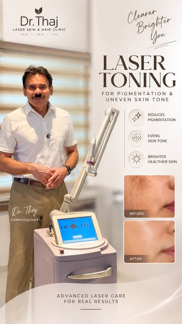 Laser Toning with Revlite Laser: A non-invasive laser treatment that targets excess pigmentation and