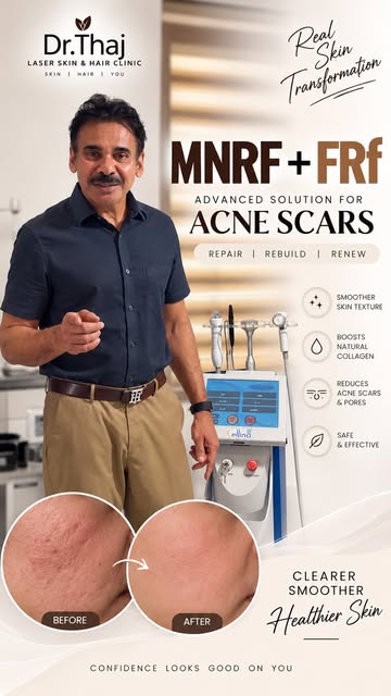 Microneedling Radiofrequency and Fractional 
Radiofrequency deliver controlled thermal energy into t