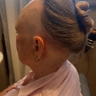 Visste du at så mange som 2% av oss vil oppleve en form for Alopecia i løpet av livet. Hårtap kan på