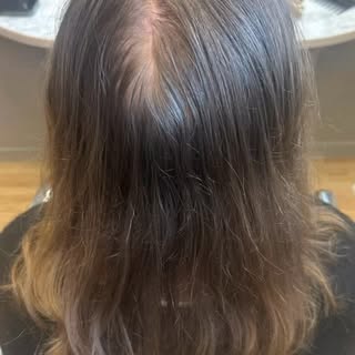 Alopecia kommer i alle aldre. Her har jeg en ung jente som har mistet mye hår, spesielt i fronten. V