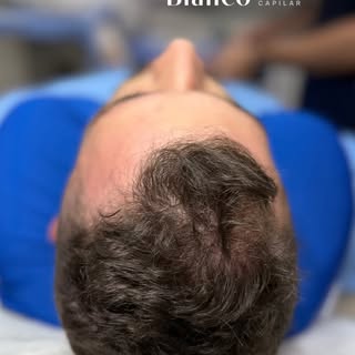 Testosterona alta e cabelo ralo?
Muita gente acha que a culpa é da testosterona, mas quem realmente 