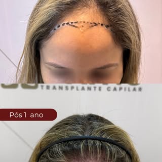 Essa paciente chegou incomodada com uma falha na linha frontal. Algo que afetava diretamente sua aut
