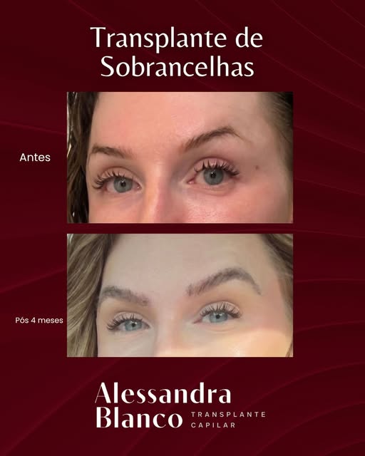 Antes do transplante de sobrancelhas, essa paciente convivia com falhas no início da sobrancelha e a