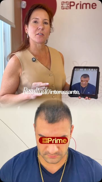 Você diria que esse paciente passou por um transplante capilar? 

Em um resultado realmente natural,