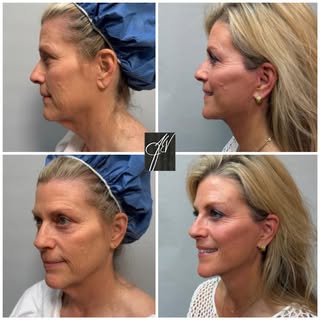 3 months out from #deepplane lower face and neck lift with full face CO2 laser ❤️

#deepplanefacelif