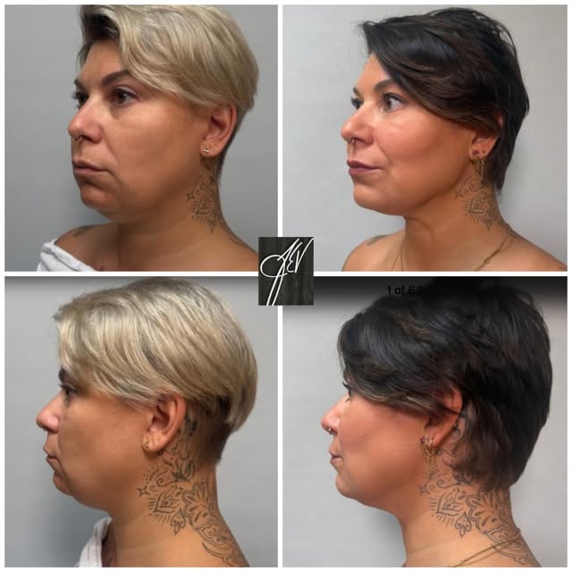 1 year out from #Facetite contouring to the lower face, jawline, and neck 💕. This is the perfect op