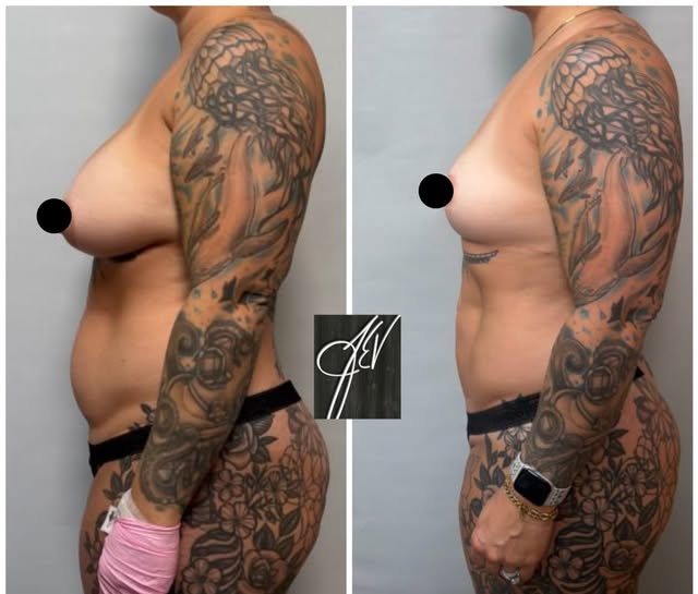 1 year from #explant of breast implants with lift and contouring abdominal #liposuction 💕

#breastl