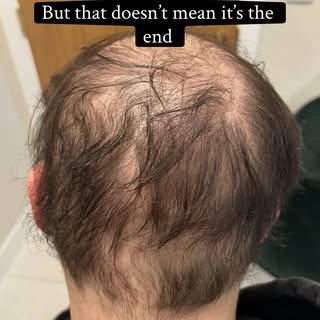 Hair Loss Journeys 🎥
Real Clients. Real Stories. Real Results.
Hair Replacement Specialist
📍 Bisho