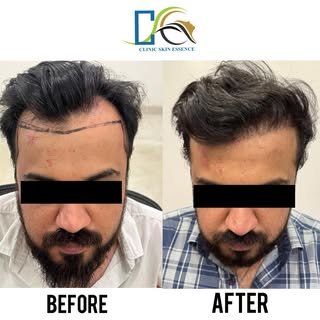 Sharing the results of FUE Hair Transplant with around 3000 grafts for our patient . Our forte:
1. N