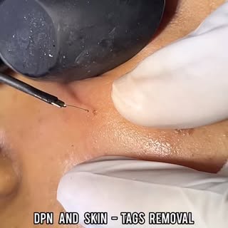 Are you suffering from skin - tags / warts / DPN’s on face ?
There can be removed easily in the clin