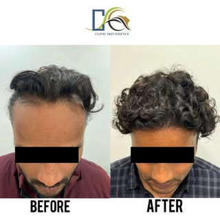 Happy to share the results of FUE Hair Transplant with around 3000 grafts for our patient. The pictu