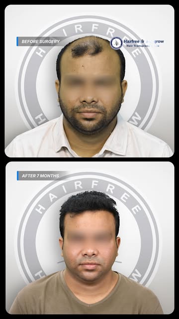7 Months Later… 😱 Grade 7 Baldness TRANSFORMATION! 

Book your appointment today!
WhatsApp: https:/