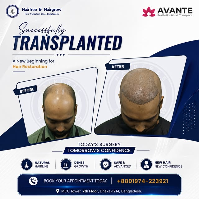 HAIR TRANSPLANT SURGERY DAY
🔹 Grafts Transplanted: 4500
🔹 Method Used: Sapphire FUE
🔹 Baldness Pa
