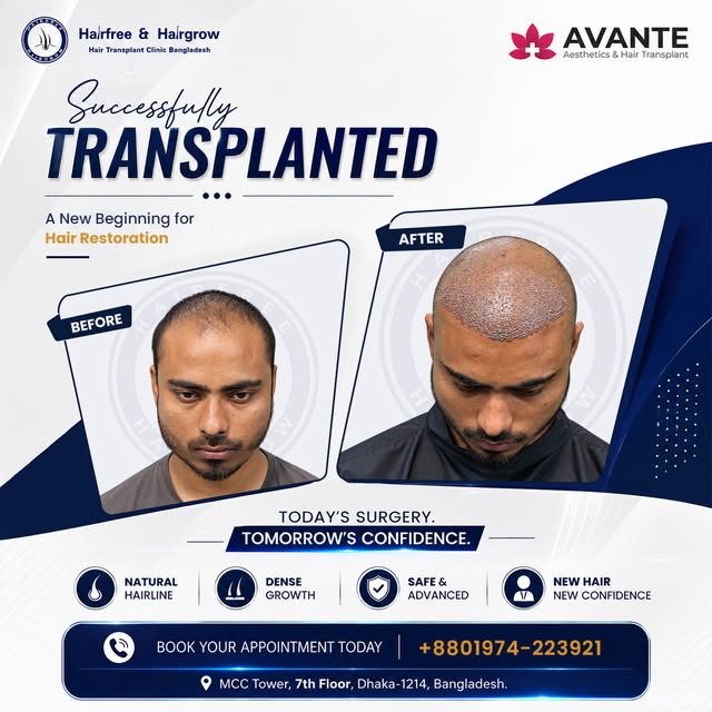 HAIR TRANSPLANT SURGERY DAY
🔹 Grafts Transplanted: 2500
🔹 Method Used: Sapphire FUE
🔹 Baldness Pa