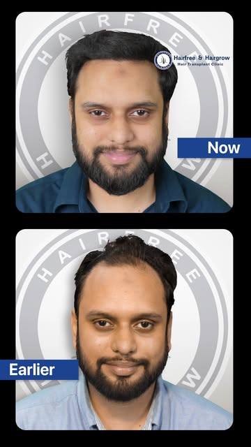 3000 Grafts, 6 Months Later! 😍 | Grade 3 Baldness Hair Transplant Transformation

Book your appoint