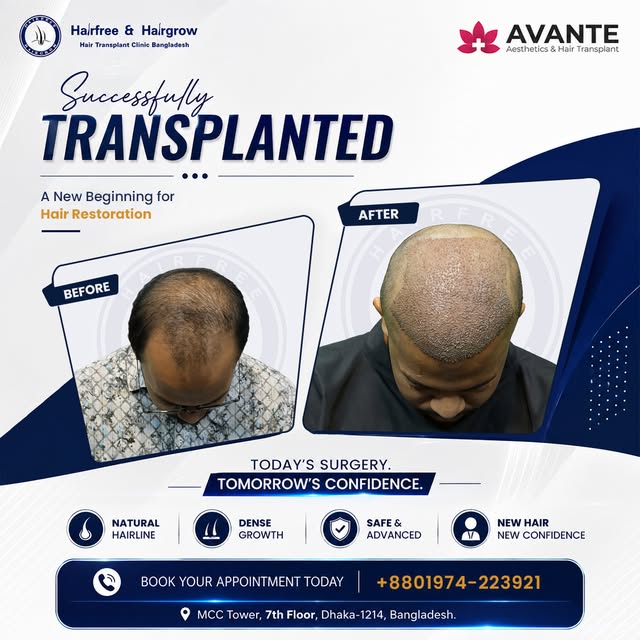 HAIR TRANSPLANT SURGERY DAY
🔹 Grafts Transplanted: 4500+
🔹 Method Used: Sapphire FUE
🔹 Baldness P
