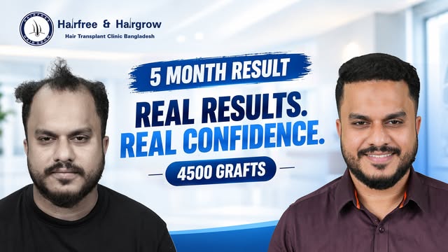 4500 Grafts Later… 😱 THIS Is the 5-Month Transformation! | Grade 5 Baldness

Book your appointment 