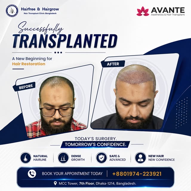 HAIR TRANSPLANT SURGERY DAY
🔹 Grafts Transplanted: 3000
🔹 Method Used: Sapphire FUE
🔹 Baldness Pa
