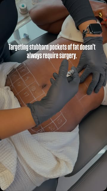 Targeting stubborn pockets of fat doesn’t always require surgery. Sculpt Shape combines a personaliz