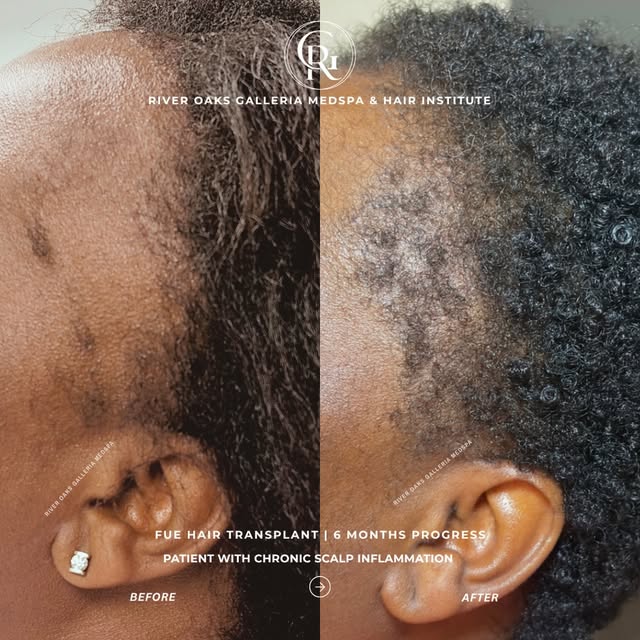 A hair transplant is only as strong as the scalp supporting it.
This patient came to ROG Hair Instit