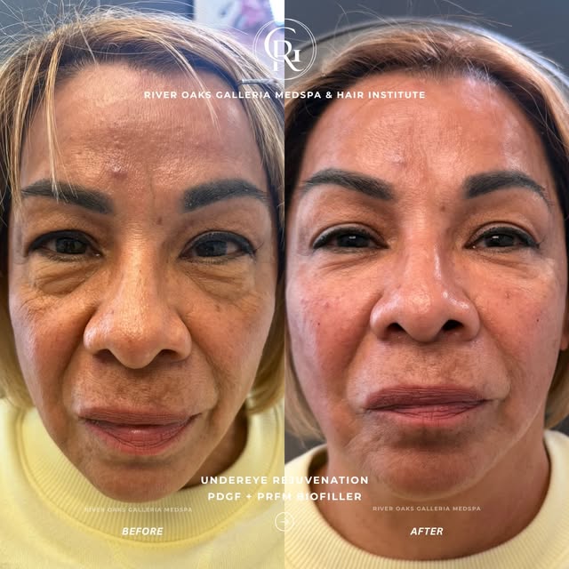 Under-eye rejuvenation isn’t always about adding traditional filler.

For patients experiencing a co