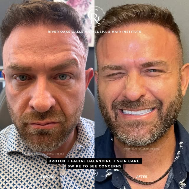 Men get facial balancing, too—and the goal doesn’t have to be changing your face.

This patient’s tr