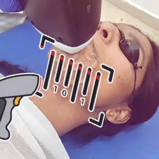 Laser hair reduction