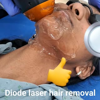 Diode laser hair removal treatment #adhyaskinandhaircare #SkincareRoutine #skincare #skincaretips #L