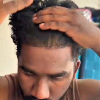 Hair transplant results 
.
.
.
.
.
.
.
.
#viral #samshoots #adhya #skin