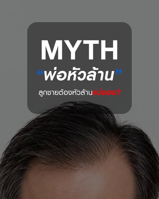 MYTH: “พ่อหัวล้าน = ลูกชายต้องหัวล้านแน่นอน?”
คำตอบคือ ไม่จริงเสมอไป ❌

แม้ภาวะผมบางจากพันธุกรรม หรื