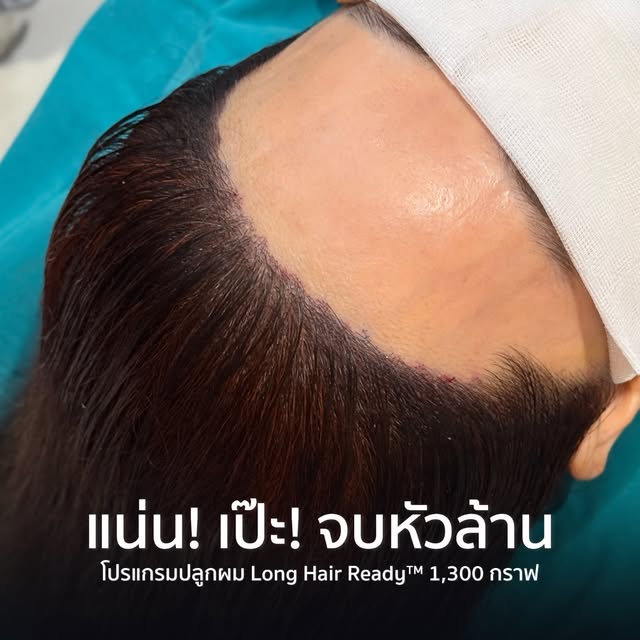 คิดว่าเลือกถูกที่…พอได้เห็นผลลัพธ์เท่านั้นแหละ! เริ่ดดดด✨ #รีวิวปลูกผมHairClinique #HairCliniquebySL