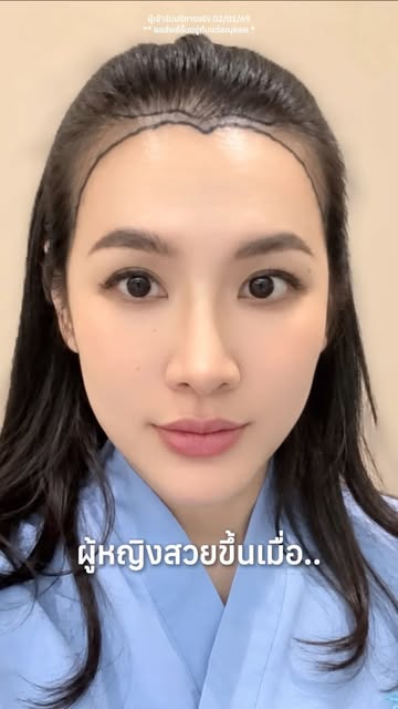 ผู้หญิงสวยขึ้นเพราะ รักตัวเอง ดูแลตัวเองกันค่ะ ✨💙
.
#haircliniquebyslc #hairclinique #รีวิวปลูกผม #