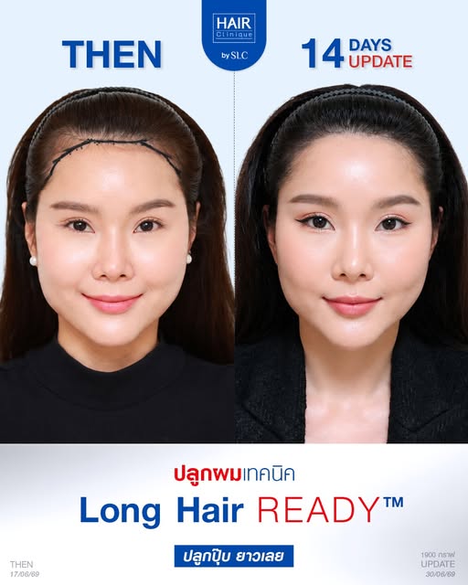 มาแชร์ไอเท็มเด็ดกู้ชีพค่าสาวๆ ใครที่ไรผมเว้าลึกทำให้ดูมีอายุ (กรี๊ดดดด)

ต้องลองโปรแกรม Long Hair RE