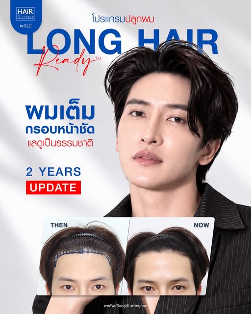 ครบ 2 ปีแล้ว…บอกเลยว่า “หล่อจริง” 💙✨

อัปเดตผลลัพธ์หลังทำ โปรแกรมปลูกผม Long Hair Ready™ ครบ 2 ปี จ