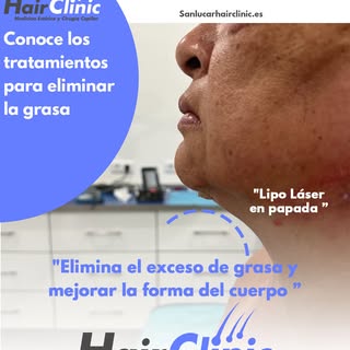 Encuentra en Sanlucar Hair Clinic la liposucción láser en zonas localizadas para ayudar a eliminar e