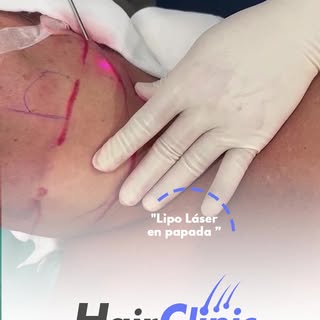 Sanlucar Hair Clinic ofrece el innovador procedimiento de liposucción con Lipo Láser para eliminar l