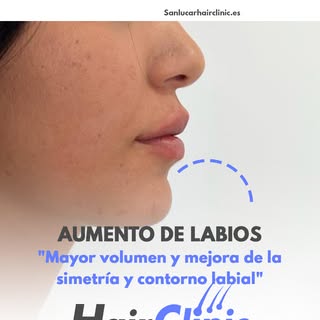 💋💉 Labios de Ensueño: Descubre el Aumento de Labios en Sanlucar Hair Clinic 💉💋

¿Quieres lucir u