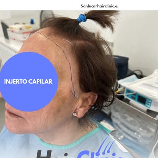 🌟 ¡Resultados Reales de Injerto Capilar! ¡7 Meses de Transformación Increíble! 🌟

En Sanlucar Hair