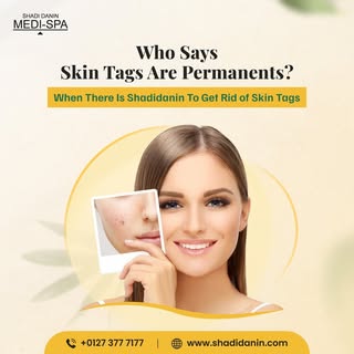 Transform your skincare routine with our advanced moles and skin tags removal treatments at Shadidan