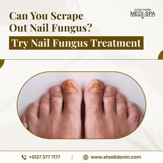 🌟 Say goodbye to nail fungus with our advanced treatments at Shadi Danin Medi Spa in Brighton! 🌟

