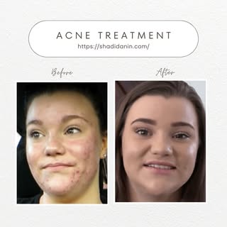 ✨ Witness the transformation! Our advanced acne treatment has worked wonders for this client. Say go