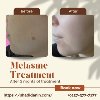 🌟 Tired of dealing with melasma and uneven skin tone? 
Our advanced melasma treatment is here to he